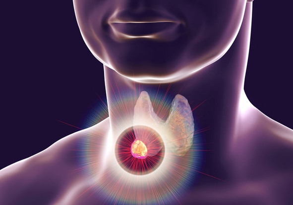Thyroid Cancer Specialist in india
